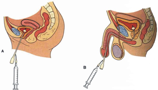 sonda urinara complicatii